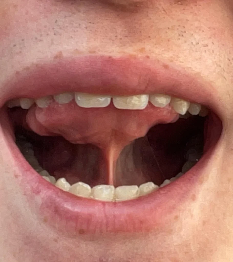 درمان خروپف با تمرینات مایوفانکشنال